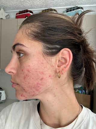 Post-Pill Acne Results with Restore Serum